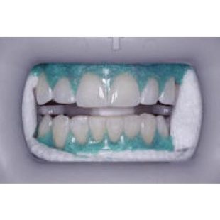 KULZER Venus White Max Light Cure Gingival Barrier 1.2 ml Syringe with 8 x Tips 4/box